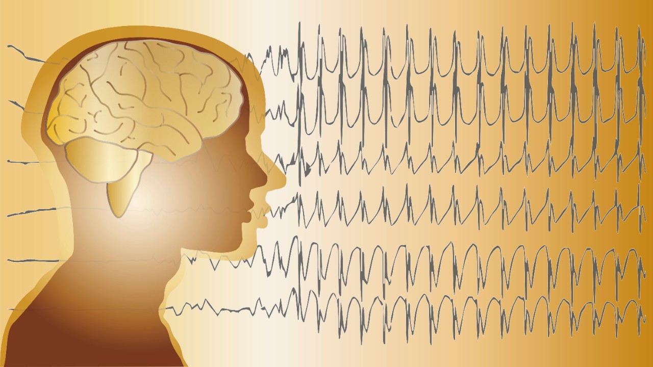 ECG bij epilepsie